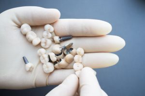 a gloved hand holding dental implants
