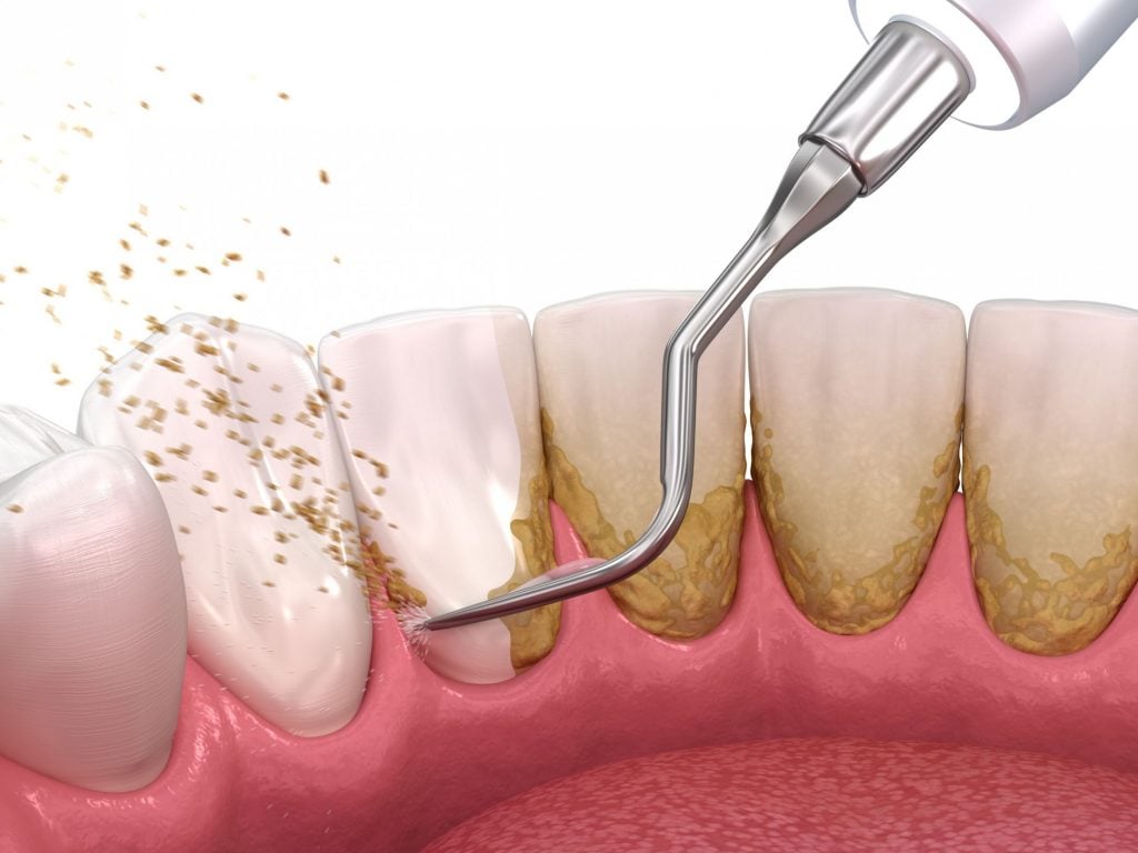 an animation of a teeth cleaning