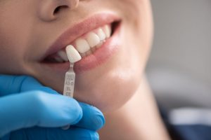 a smiling woman with veneers