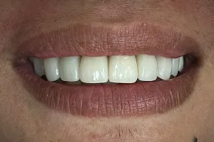 a close-up smile of a patient with perfect teeth