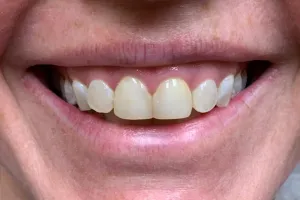 a smiling patient's teeth