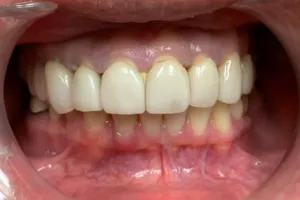 a close-up of a patient's mouth and teeth
