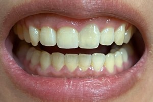 Broken tooth dental repair before and after result. Close-up of restored and smooth upper front teeth after cosmetic dental bonding.