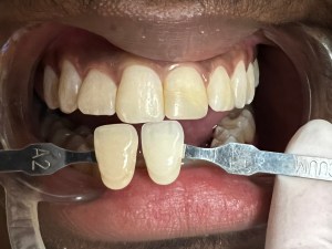 Dentist using a tooth shade guide tabs next to patient's front teeth to match color for natural-looking dental veneers or composite resin.
