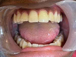 Completed cosmetic dentistry treatment showing natural-looking smile with restored, uniform, and healthy upper front teeth.