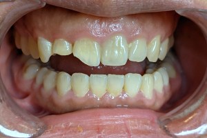 Chipped tooth before cosmetic dentistry repair. Close-up of fractured upper front incisor tooth before dental bonding treatment.